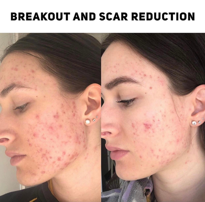 Clearing Anti Breakout Serum 50ml